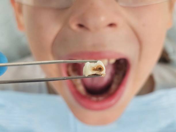 Best Emergency Dental Extractions in Orchard Grass Hills, KY